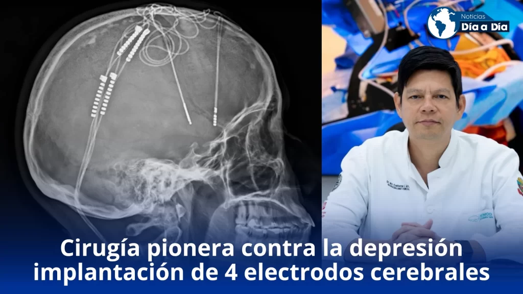 Cirugía pionera contra la depresión HIC implanta cuatro electrodos cerebrales en intervención única en Colombia